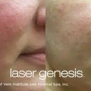 Laser Genesis before and after photo by La Bella Laser & Slimming Inc. in Arcadia, CA