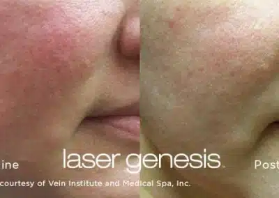 Laser Genesis before and after photo by La Bella Laser & Slimming Inc. in Arcadia, CA
