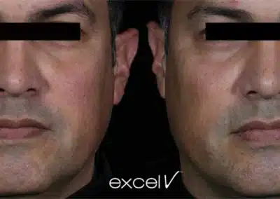 Laser Genesis before and after photo by La Bella Laser & Slimming Inc. in Arcadia, CA