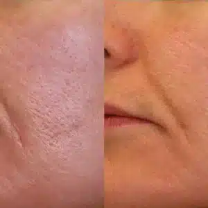 Laser Genesis before and after photo by La Bella Laser & Slimming Inc. in Arcadia, CA