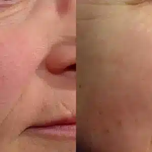 Laser Genesis before and after photo by La Bella Laser & Slimming Inc. in Arcadia, CA