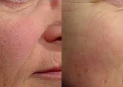 Laser Genesis before and after photo by La Bella Laser & Slimming Inc. in Arcadia, CA