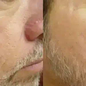 Laser Genesis before and after photo by La Bella Laser & Slimming Inc. in Arcadia, CA