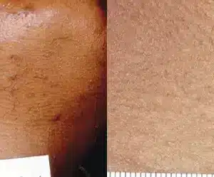 Laser Hair Removal before and after photo by La Bella Laser & Slimming Inc. in Arcadia, CA