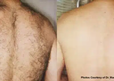 Laser Hair Removal before and after photo by La Bella Laser & Slimming Inc. in Arcadia, CA
