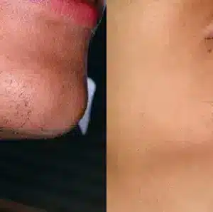 Laser Hair Removal before and after photo by La Bella Laser & Slimming Inc. in Arcadia, CA