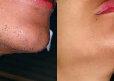 Laser Hair Removal before and after photo by La Bella Laser & Slimming Inc. in Arcadia, CA