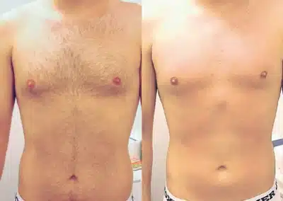 Laser Hair Removal before and after photo by La Bella Laser & Slimming Inc. in Arcadia, CA