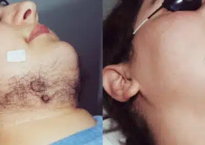 Laser Hair Removal before and after photo by La Bella Laser & Slimming Inc. in Arcadia, CA