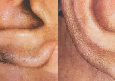 Laser Hair Removal before and after photo by La Bella Laser & Slimming Inc. in Arcadia, CA