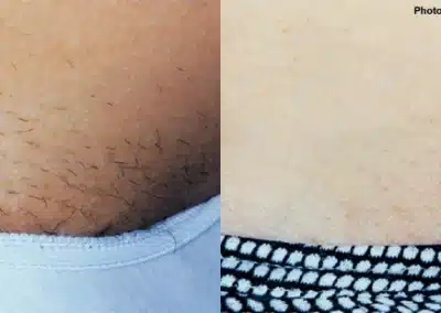 Laser Hair Removal before and after photo by La Bella Laser & Slimming Inc. in Arcadia, CA
