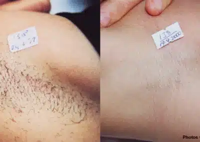 Laser Hair Removal before and after photo by La Bella Laser & Slimming Inc. in Arcadia, CA