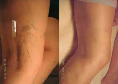 Laser Vein Removal before and after photo by La Bella Laser & Slimming Inc. in Arcadia, CA