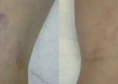 Laser Vein Removal before and after photo by La Bella Laser & Slimming Inc. in Arcadia, CA