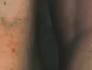 Laser Vein Removal before and after photo by La Bella Laser & Slimming Inc. in Arcadia, CA