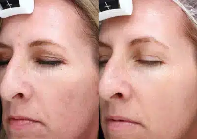 Micro Needling Skin Resurfacing before and after photo by La Bella Laser & Slimming Inc. in Arcadia, CA
