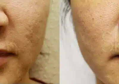 Micro Needling Skin Resurfacing before and after photo by La Bella Laser & Slimming Inc. in Arcadia, CA