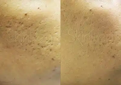 Micro Needling Skin Resurfacing before and after photo by La Bella Laser & Slimming Inc. in Arcadia, CA