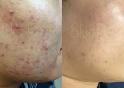 Micro Needling Skin Resurfacing before and after photo by La Bella Laser & Slimming Inc. in Arcadia, CA