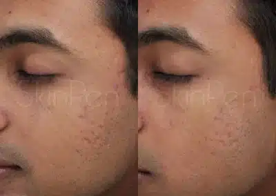 Micro Needling Skin Resurfacing before and after photo by La Bella Laser & Slimming Inc. in Arcadia, CA