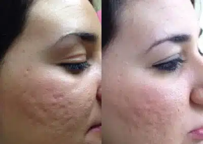 Micro Needling Skin Resurfacing before and after photo by La Bella Laser & Slimming Inc. in Arcadia, CA
