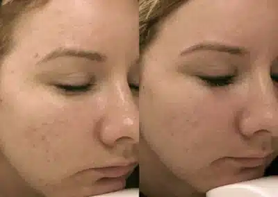 Micro Needling Skin Resurfacing before and after photo by La Bella Laser & Slimming Inc. in Arcadia, CA