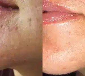 Micro Needling Skin Resurfacing before and after photo by La Bella Laser & Slimming Inc. in Arcadia, CA