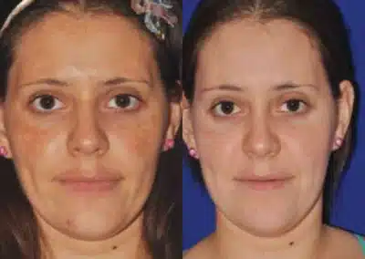 Micro Needling Skin Resurfacing before and after photo by La Bella Laser & Slimming Inc. in Arcadia, CA