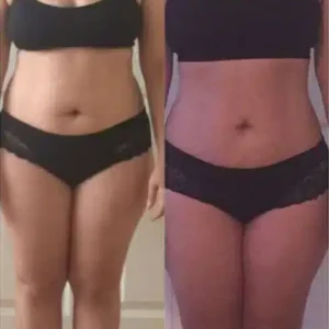 I-Lipo Fat Reduction before and after photo by La Bella Laser & Slimming Inc. in Arcadia, CA