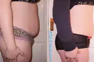 I-Lipo Fat Reduction before and after photo by La Bella Laser & Slimming Inc. in Arcadia, CA