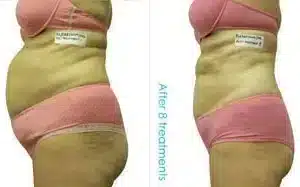 I-Lipo Fat Reduction before and after photo by La Bella Laser & Slimming Inc. in Arcadia, CA