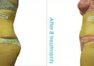 I-Lipo Fat Reduction before and after photo by La Bella Laser & Slimming Inc. in Arcadia, CA