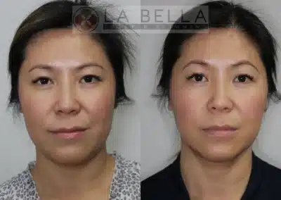 MINT® Lift before and after photo by La Bella Laser & Slimming Inc. in Arcadia, CA