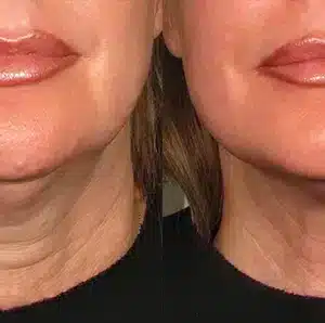 Ultherapy Non Invasive Face lift before and after photo by La Bella Laser & Slimming Inc. in Arcadia, CA