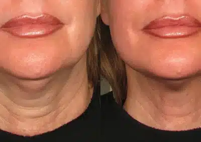 Ultherapy Non Invasive Face lift before and after photo by La Bella Laser & Slimming Inc. in Arcadia, CA