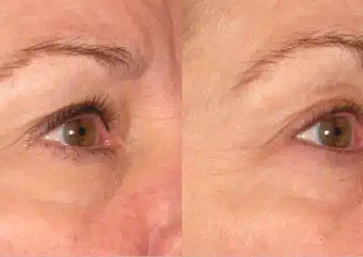 Ultherapy Non Invasive Face lift before and after photo by La Bella Laser & Slimming Inc. in Arcadia, CA
