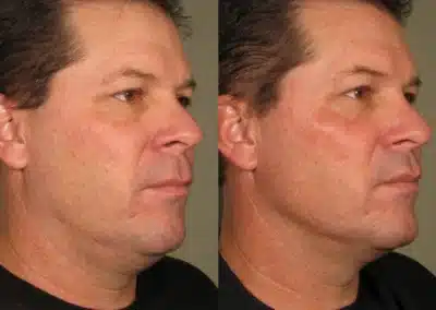Ultherapy Non Invasive Face lift before and after photo by La Bella Laser & Slimming Inc. in Arcadia, CA