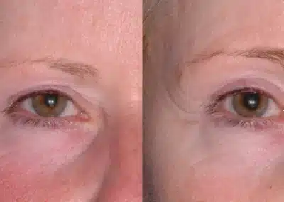 Ultherapy Non Invasive Face lift before and after photo by La Bella Laser & Slimming Inc. in Arcadia, CA