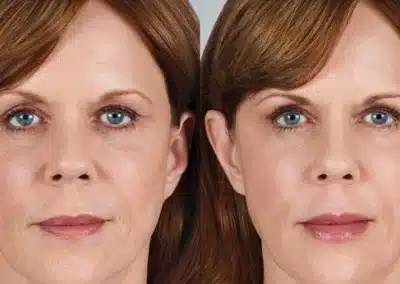 Volbellaâ„¢ XC before and after photo by La Bella Laser & Slimming Inc. in Arcadia, CA