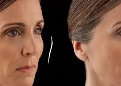 Volumaâ„¢ XC before and after photo by La Bella Laser & Slimming Inc. in Arcadia, CA