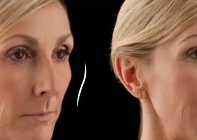 Volumaâ„¢ XC before and after photo by La Bella Laser & Slimming Inc. in Arcadia, CA