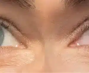 Latisse before and after photo by La Bella Laser & Slimming Inc. in Arcadia, CA