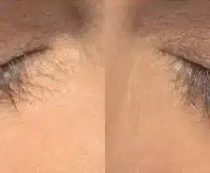 Latisse before and after photo by La Bella Laser & Slimming Inc. in Arcadia, CA