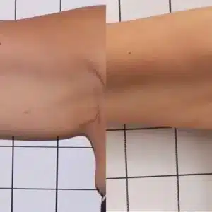 Venus Freeze Cellulite Reduction before and after photo by La Bella Laser & Slimming Inc. in Arcadia, CA