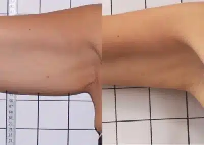 Venus Freeze Cellulite Reduction before and after photo by La Bella Laser & Slimming Inc. in Arcadia, CA