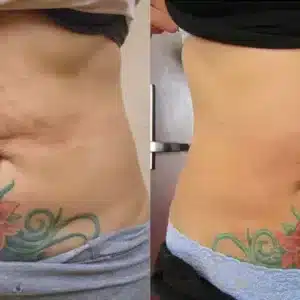 Venus Freeze Cellulite Reduction before and after photo by La Bella Laser & Slimming Inc. in Arcadia, CA