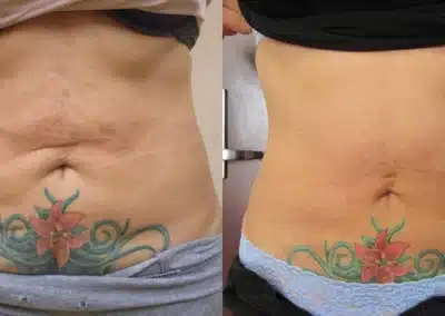 Venus Freeze Cellulite Reduction before and after photo by La Bella Laser & Slimming Inc. in Arcadia, CA