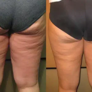 Venus Freeze Cellulite Reduction before and after photo by La Bella Laser & Slimming Inc. in Arcadia, CA