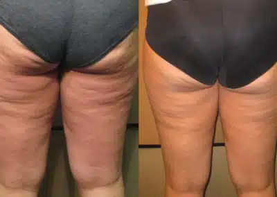 Venus Freeze Cellulite Reduction before and after photo by La Bella Laser & Slimming Inc. in Arcadia, CA