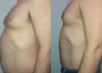 Venus Freeze Cellulite Reduction before and after photo by La Bella Laser & Slimming Inc. in Arcadia, CA